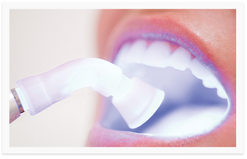 Zahnaufhellung oder auch Laser-Zahnleaching genannt - weisse Zähne durch sanfte Laserbehandlung in Bremen.